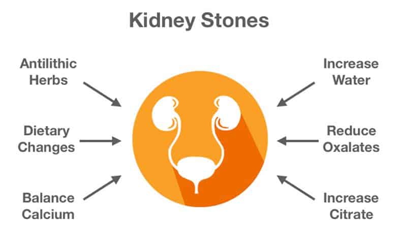 kidney stones in guelph